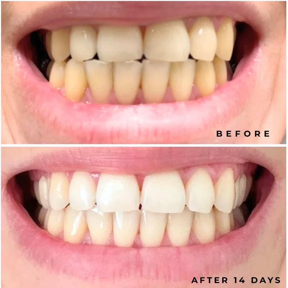 Before and after dental treatment showing teeth with yellow discoloration改善后的牙齿