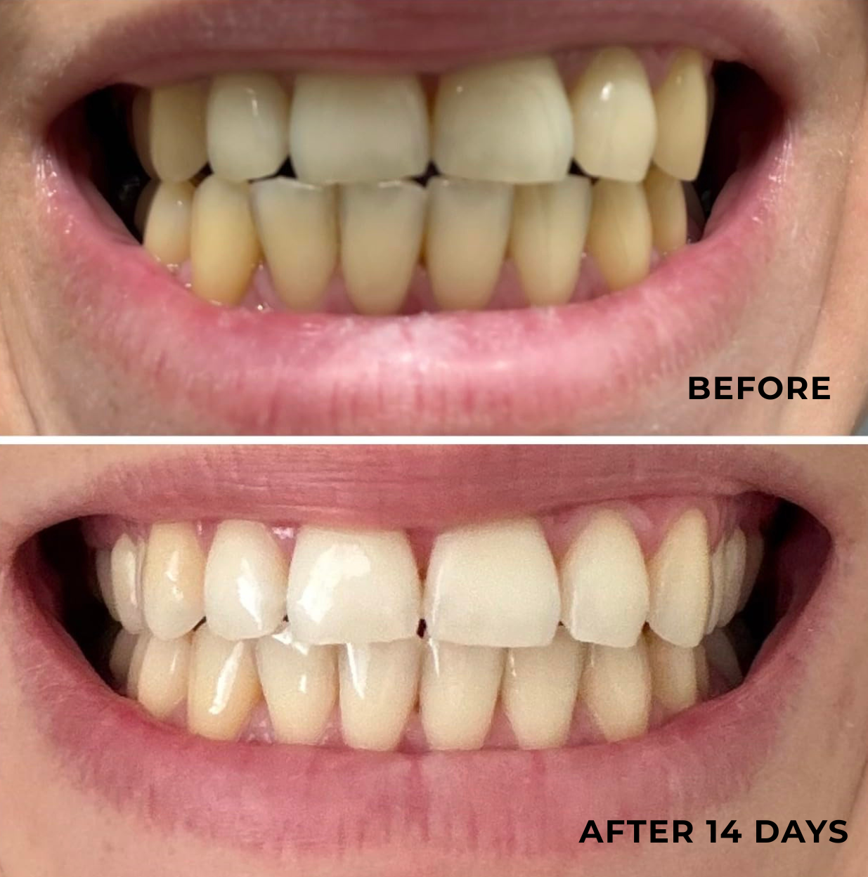 Nacre™ Teeth-Whitening Powder